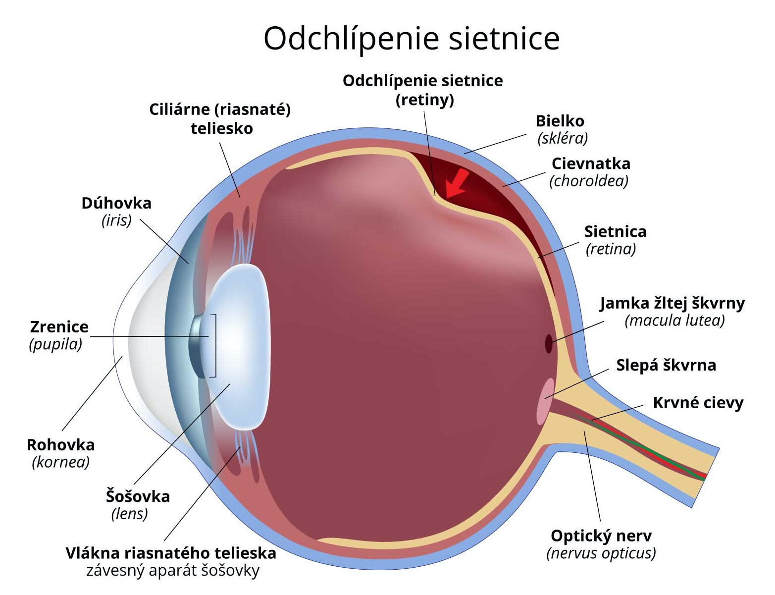 Odchlípení sítnice